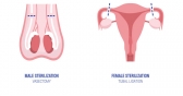 Sterilization Procedures for Women and Men